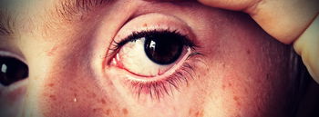 Das Bild zeigt ein gerötetes Auge.